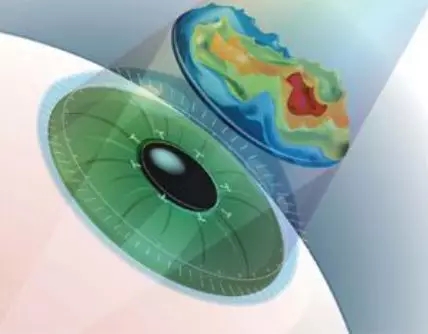 激光近視矯正和ICL晶體植入近視矯正攻略，